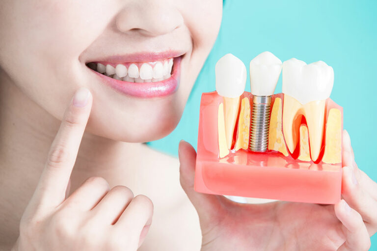 Everything to know about dental implant procedure