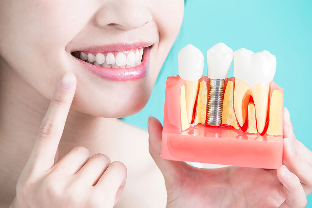 Everything to know about dental implant procedure